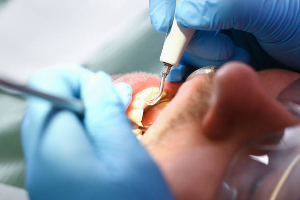 Best Emergency Treatment for Dental Infections or Abscesses in Geneva, IL