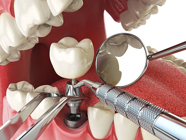 Best Emergency Tooth Extraction in Geneva, IL